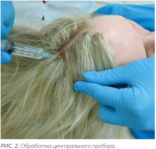 Биорепарация волосистой части головы. Асептическая обработка и обкалывание центрального пробора