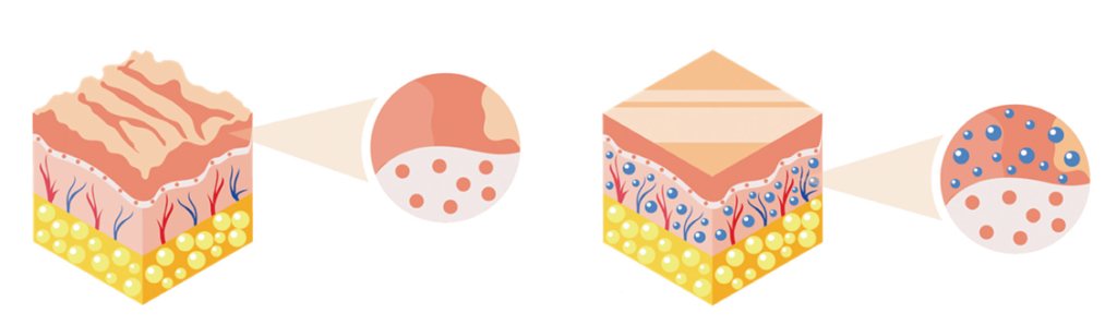  Схема монотерапия IPL без предпроцедурной подготовки и постпроцедурного ухода