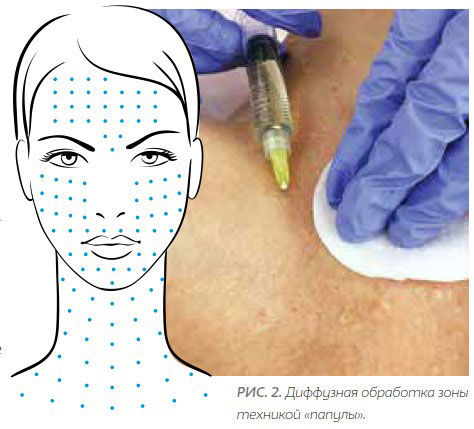 Схема диффузной обработки зоны лицо-шея-декольте биорепарантом Гиалрипайер-06