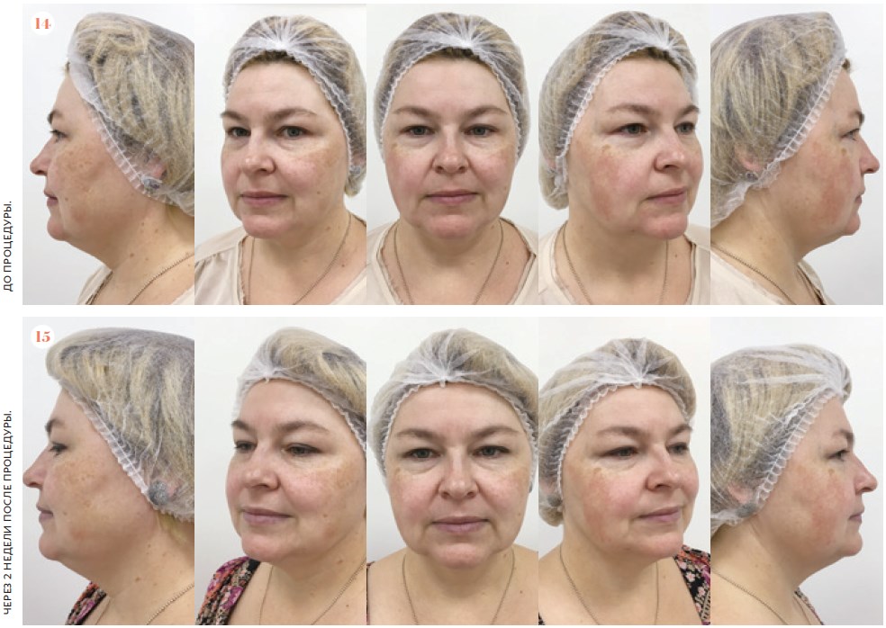 Биорепарация для коррекции возрастных изменений в зоне лицо-шея-декольте. Фото до и после биорепарации