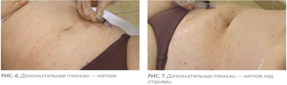 Протокол процедуры биорепарации тела. Дополнительные техники для выравнивание рельефа кожи, подтяжка