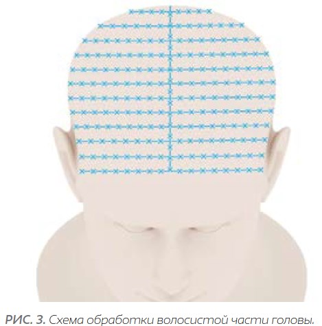 Биорепарация волосистой части головы. Схема обработка и обкалывание всей волосистой части головы