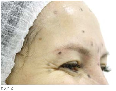 Разметка лица перед ботулинотерапией. Круговая мышца глаза